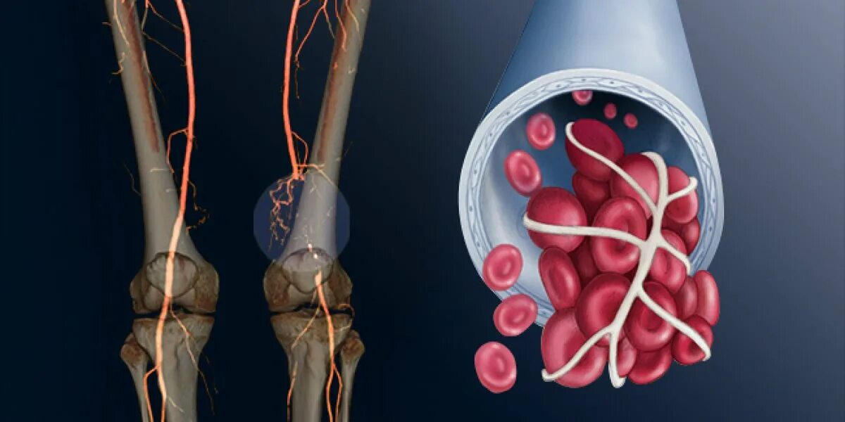 Тромбоз артерии лечение. Венозная тромбоэмболия. Сосудистая патология нижних конечностей.