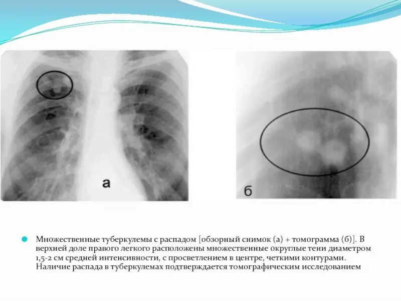 Множественные округлые. Туберкулема фтизиатрия. Туберкулома на кт. Туберкулема рентген описание. Солитарная туберкулема.