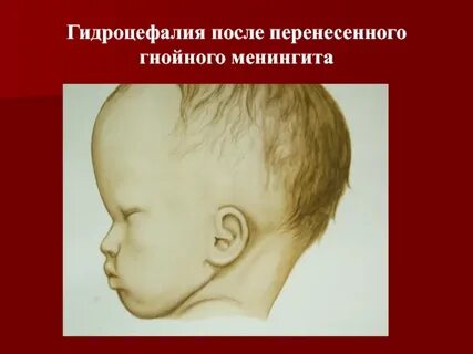 Гнойный перенести