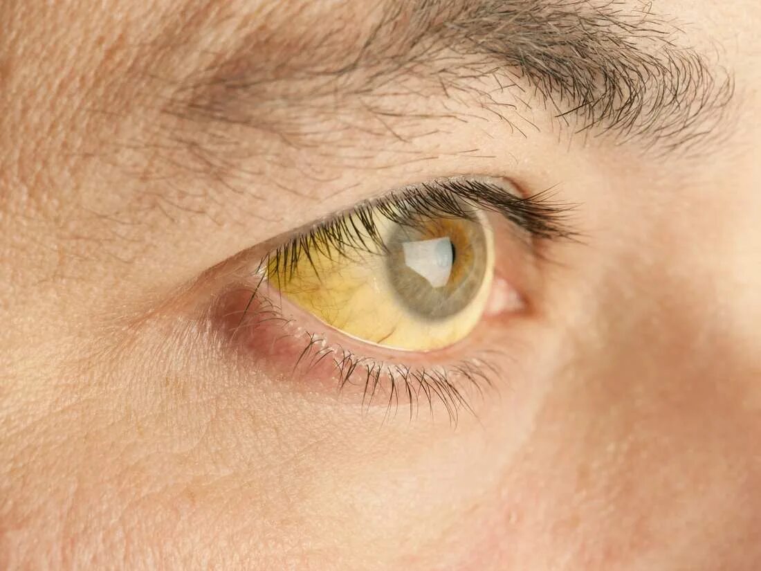 Желтые глаза лечение. Синдром Жильбера желтые глаза. Синдром Жильбера пожелтение склер. Пожелтение склер гепатит.