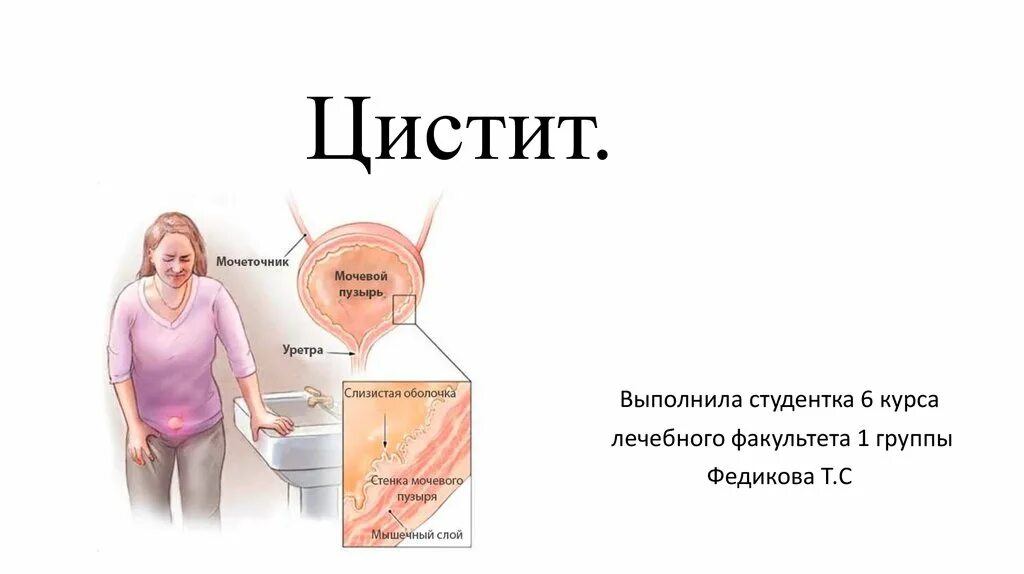 Рецидив цистита. Цистит схема.