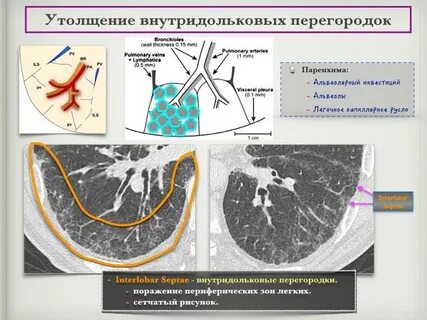 Междольковые интерстиции
