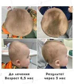 Брахиоцефалия