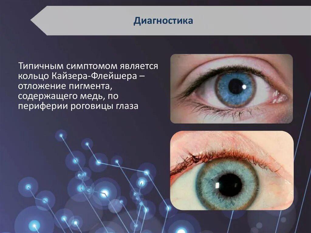 Меланин цвет глаз. От чего зависит цвет глаз. Оболочка глаза содержащая пигмент называется. В радужке расположены. Болезнь вильсона коновалова медь кольцо.
