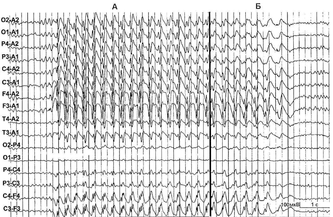 ЭЭГ эпилепсия пик-волна. ЭЭГ В норме и при эпилепсии. Гипервентиляция ЭЭГ. Фаст Активити на ЭЭГ.