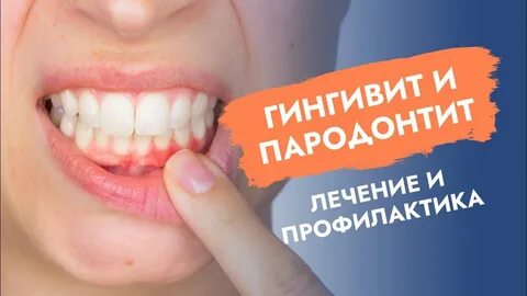 Пародонтоз лечение домашними средствами