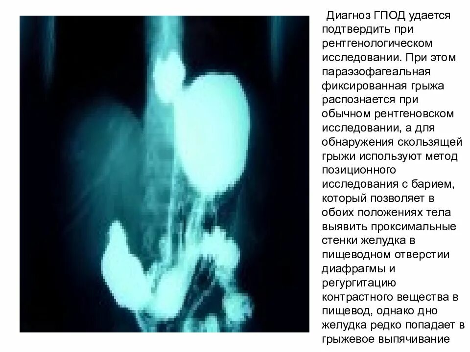 Гпод в гастроэнтерологии что