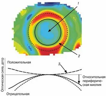 Линзы останавливающие миопию