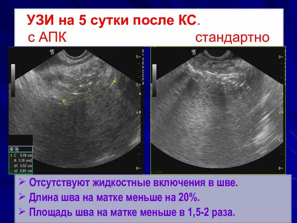 Когда после кесарева можно заниматься интимной. УЗИ после кесарево сечение.