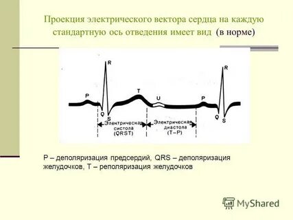 Деполяризация предсердий