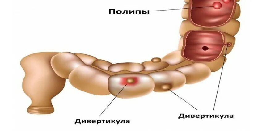 Дивертикулез сигмовидной кишки диета лечение. Дивертикулы сигмовидной кишки. Дивертикукулы сигмовидной кишки. Дивертикулез дивертикулит толстой кишки. Дивертикулы толстой кишки колоноскопия.