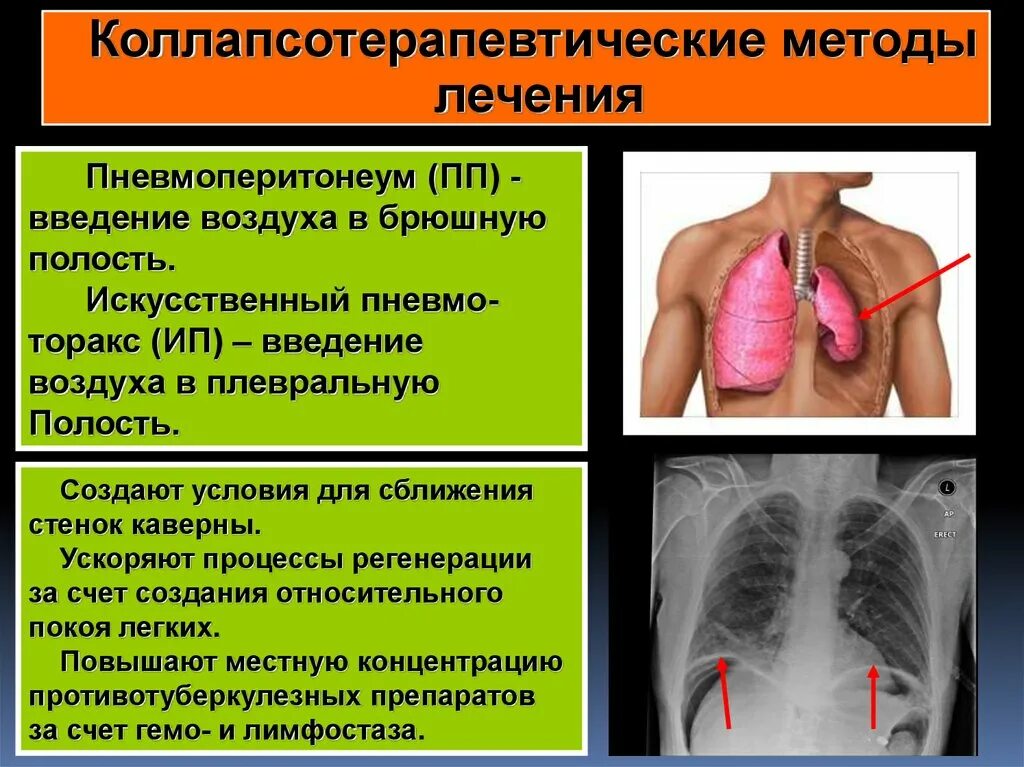 Терапевтический туберкулез