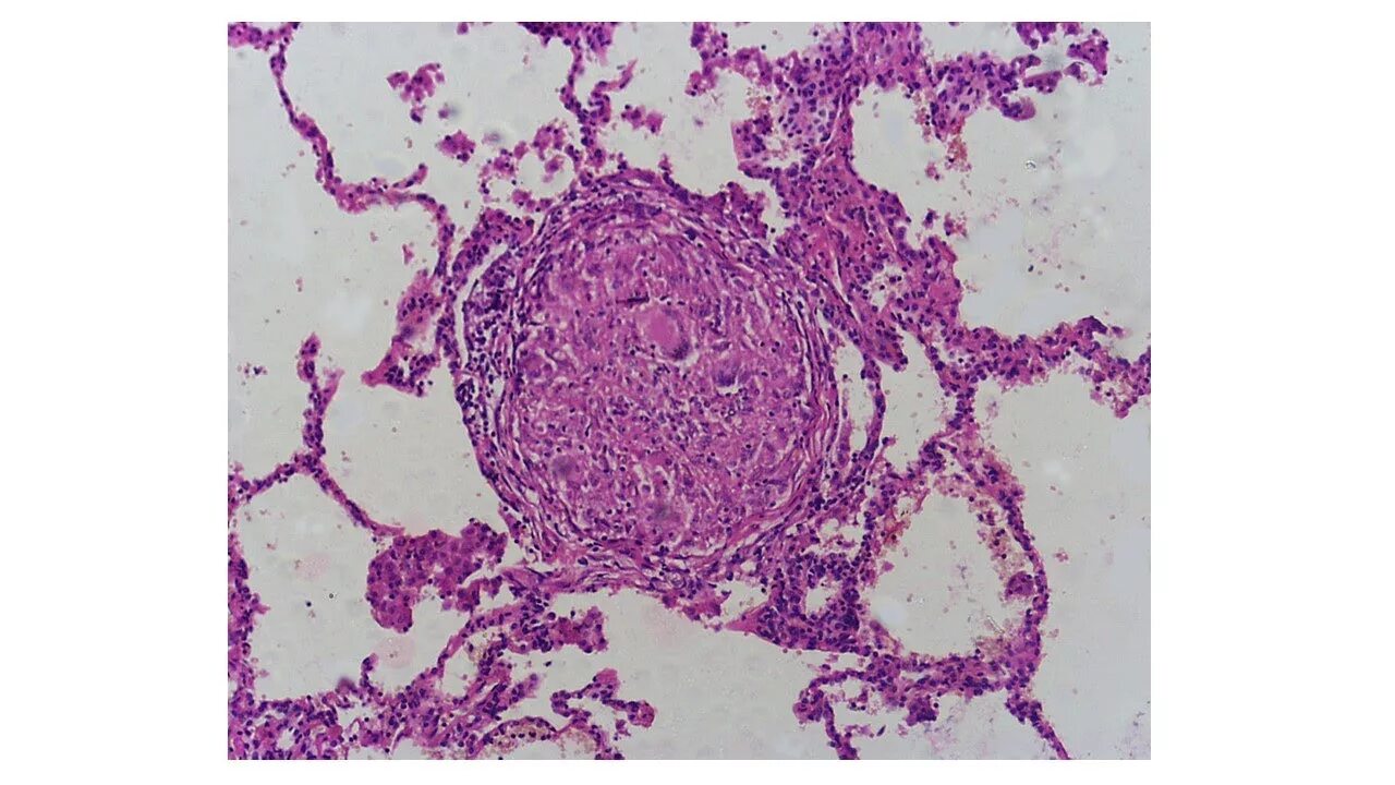 Макрофагальная гранулема гистология. Саркоидоз легких патологическая анатомия. Саркоидная гранулема гистология. Саркоидоз легких патанатомия. Саркоидная гранулема