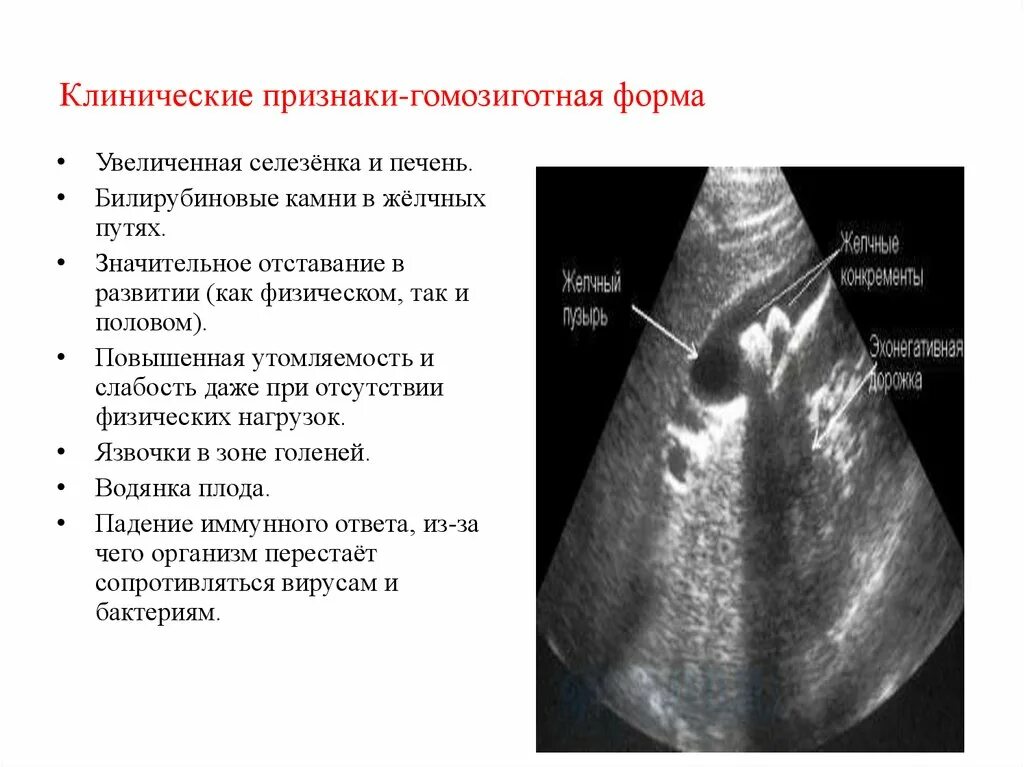 Симптомы увеличенной селезенки