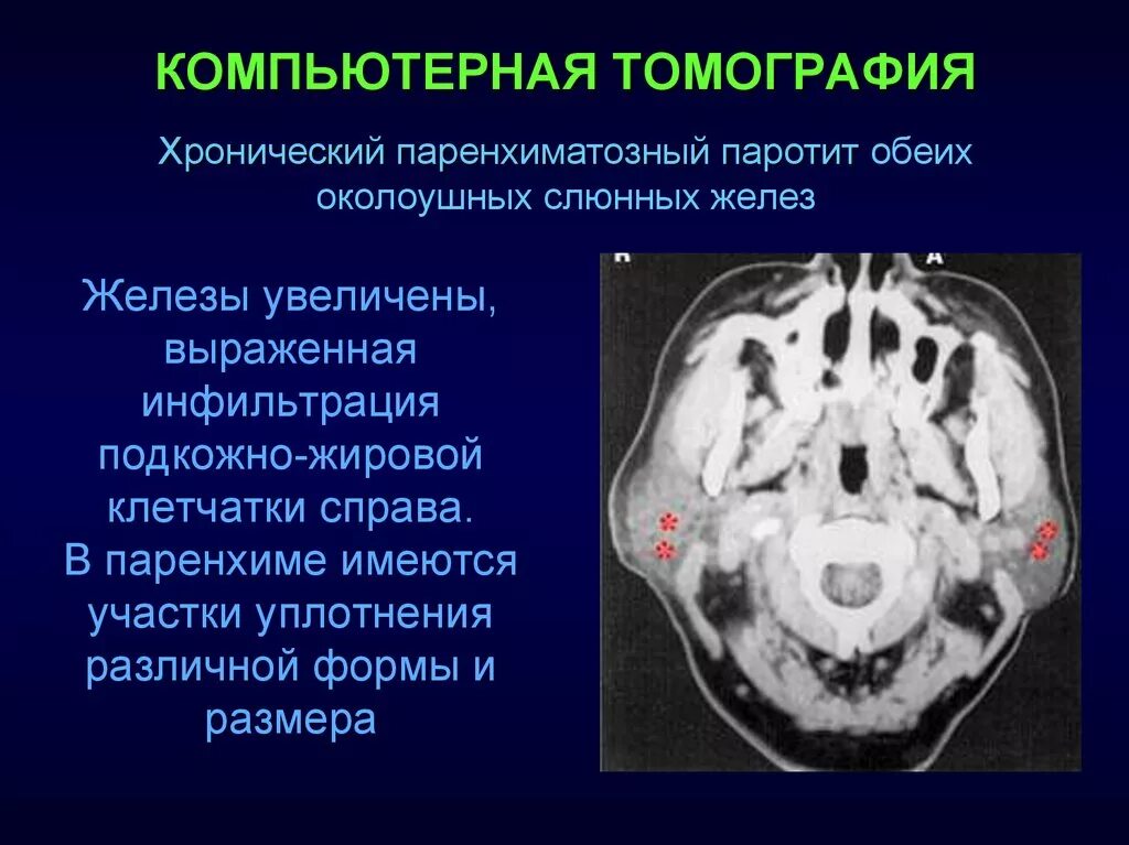 Слюнные железы кт норма. Подчелюстная слюнная железа на кт. Воспаление слюнной железы кт. Слюнные железы кт заключение. Образование околоушных желез