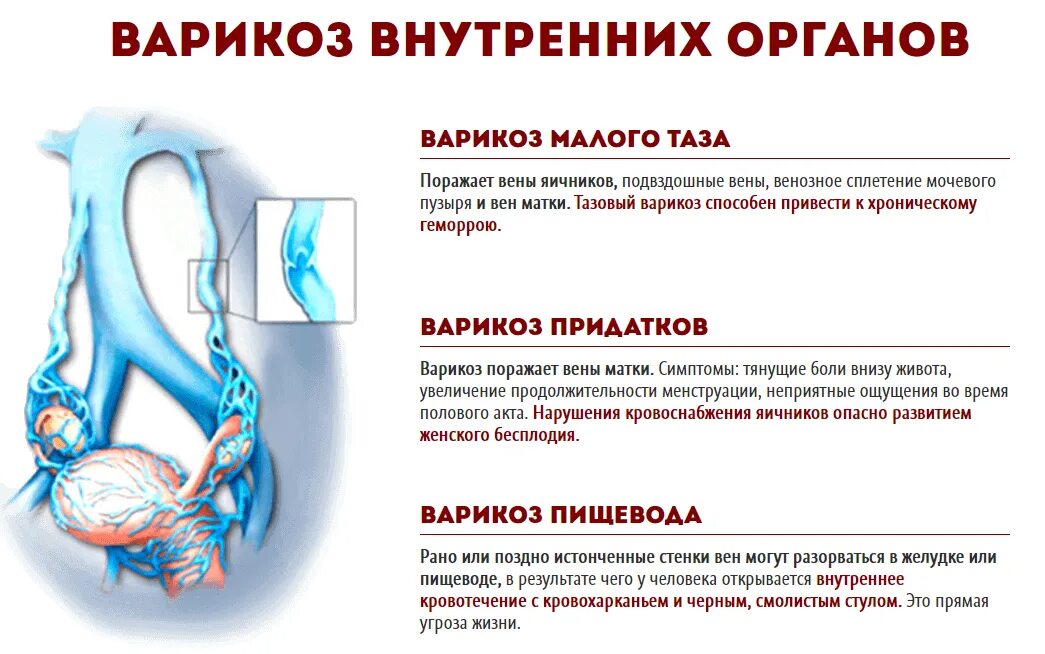 Варикоз органов таза у женщин. Препараты при варикозе малого таза. Классификация варикоза. Расширенные вены в Малом тазу.