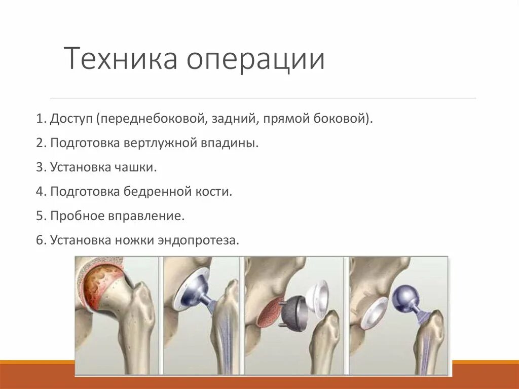 Операция по эндопротезированию отзывы. Протокол эндопротезирования тазобедренного сустава. эндопротезирование суставов презентация. эндопротезирование тазобедренного сустава. эндопротезирование тазобедренного сустава операция.
