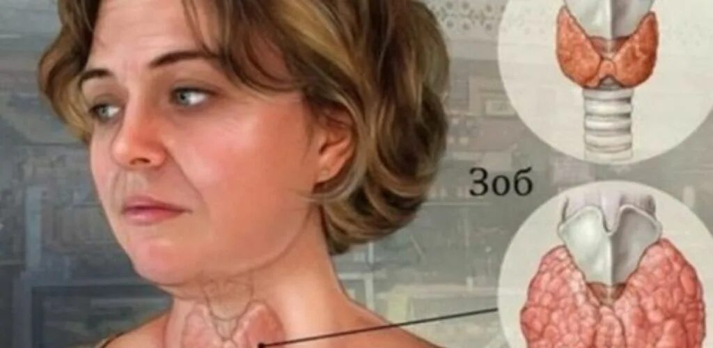 Зоб что это такое как лечить. Узловой зоб щитовидной железы. узловатый зоб щитовидной железы. узловой токсический зоб.