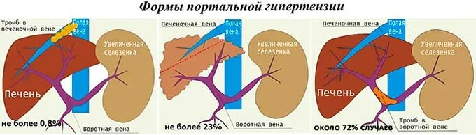 Гипертонии печень. Классификация портальной гипертензии циррозов печени. Цирроз печени синдром портальной гипертензии. Печеночная форма портальной гипертензии. Формы синдрома портальной гипертензии.