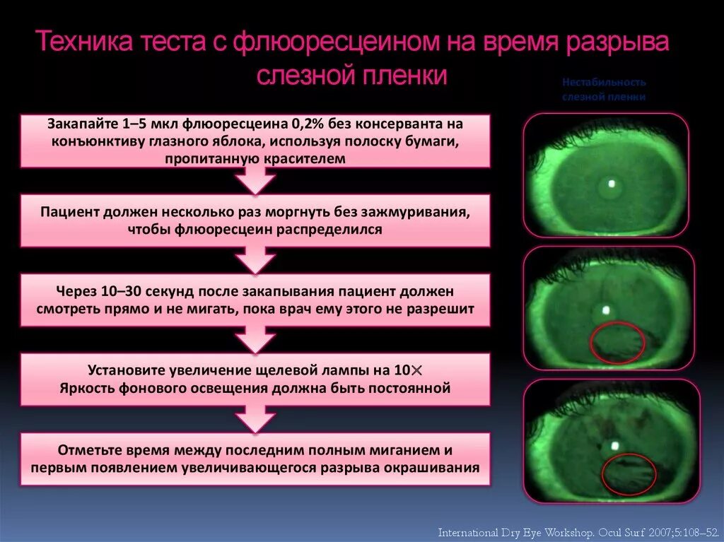 В результате разрыва. Флюоресцеиновая проба роговицы. Флюоресцеиновая проба в офтальмологии. Разрыв слезной пленки в норме.