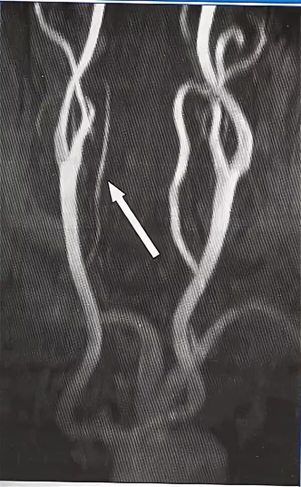 Гипоплазия позвоночной артерии. Гипоплазия v4 позвоночной артерии. Аплазия позвоночной артерии. Аплазия позвоночной артерии мрт.