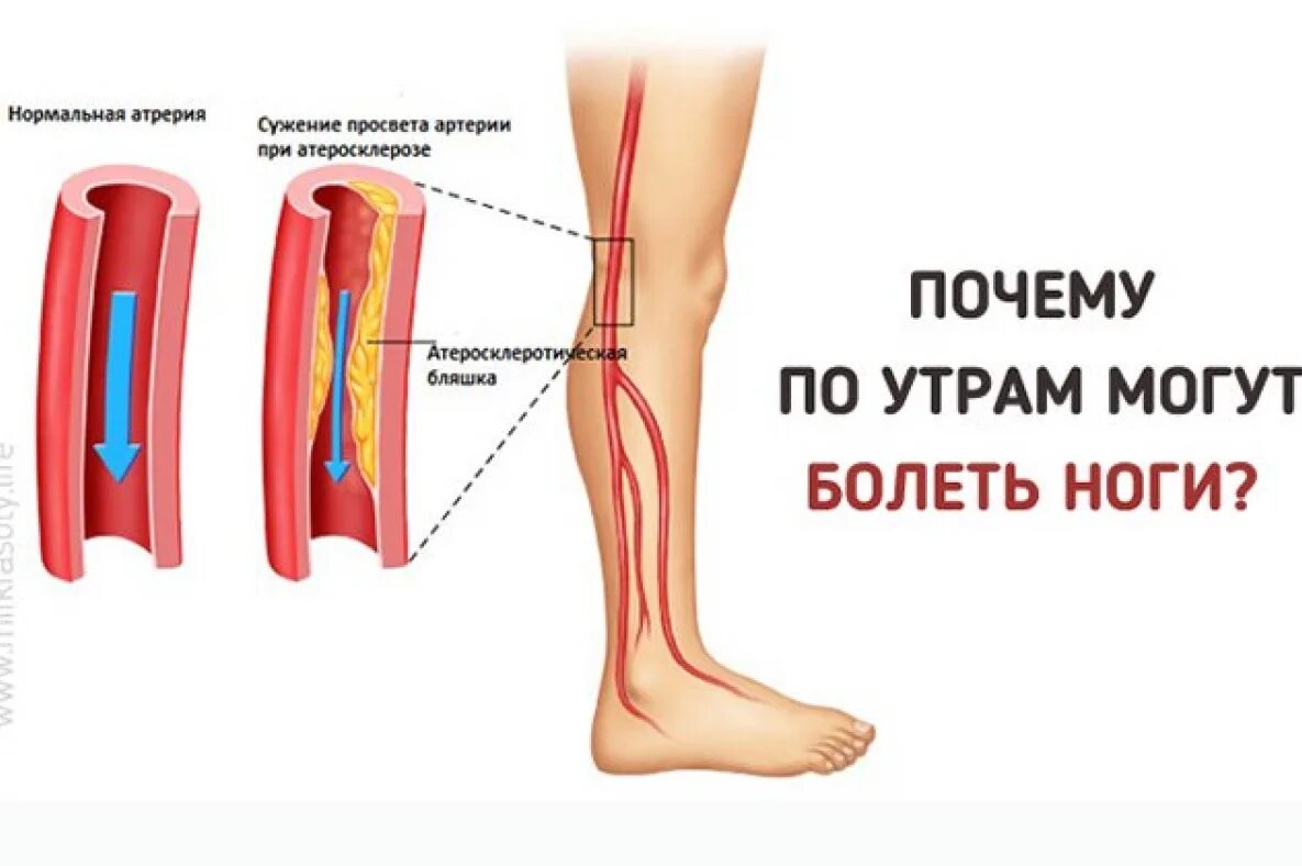 Сильно болит нога начиная