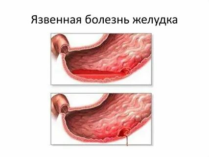 Язвенная болезнь в стадии обострения