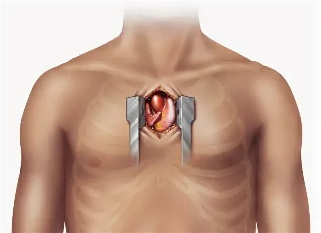 Неполная инволюция вилочковой железы. Тонкоигольная биопсия тимуса. Диета при миастении стол. Заболевания вилочковой железы у взрослых. Удаление вилочковой железы.