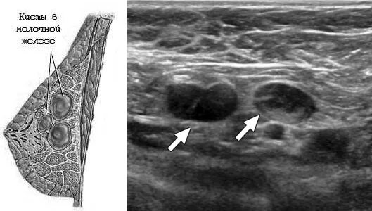 Солитарная киста молочной железы что это такое. Фиброзно-кистозная мастопатия на УЗИ. Внутрипротоковая киста молочной железы. Мелкодольчатая фиброаденома. Железы кистозно расширены