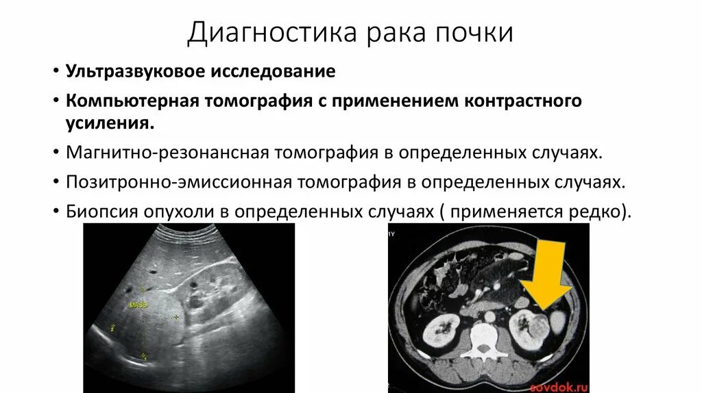 Ангиомиолипома почки протокол УЗИ. Опухоль почки диагностика. Диагноз опухоль почки на УЗИ. Метод диагностики опухоли почек. Опухоль почек у женщин