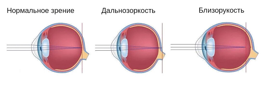 Глаза биологи. Строение глаза близорукость и дальнозоркость. Форма глаза при близорукости и дальнозоркости. Близорукость строение глаза. Схема строения глазного яблока при близорукости.