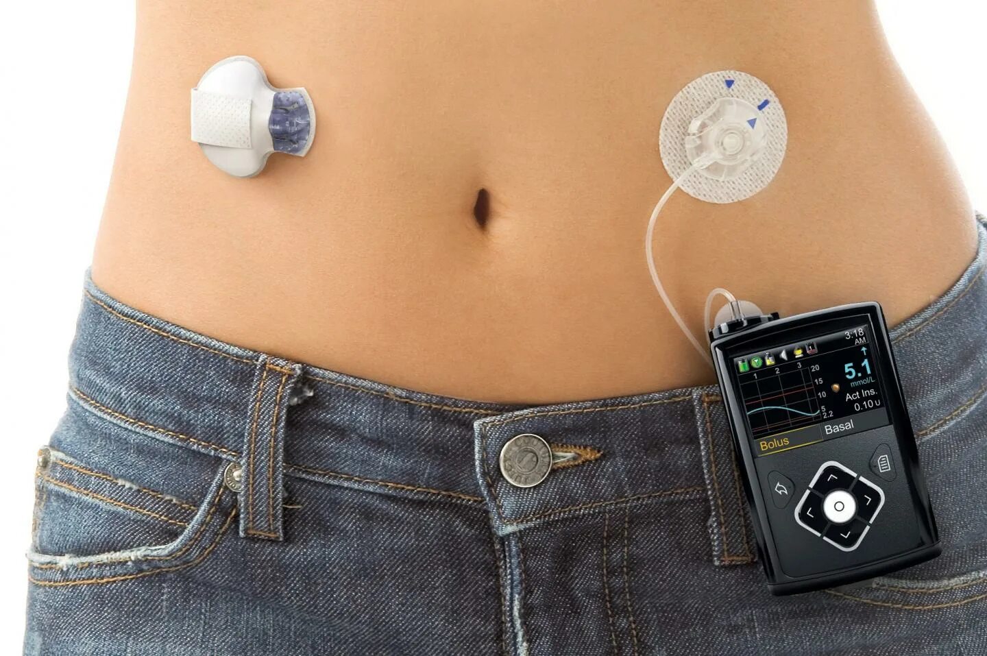 Medtronic minimed. Медтроник помпа инсулиновая 670. инсулиновая помпа медтроник 722. инсулиновая помпа paradigm real-time mmt-722/522 (medtronic, сша). медтроник 780 инсулиновая помпа.