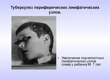 6 туберкулезная