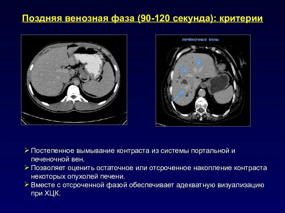 Фазы кт. Накопление контрастного вещества при кт. накопление контраста на кт. фазы кт с контрастом.