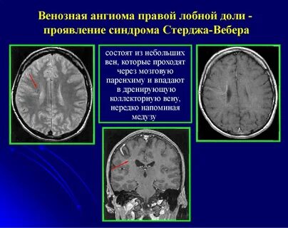 Кавернозная венозная мальформация