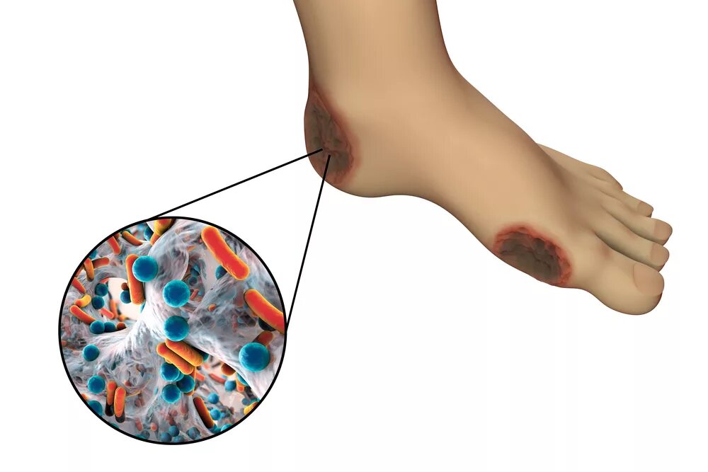Диабетическая стопа, гангрена, сепсис. Газовая гангрена диабетическая стопа. Диабетическая гангрена голени. Диабетической гангрены конечности.
