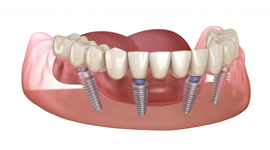 Имплантация зубов по технологии «all on 4». Имплантация челюсти на 4 имплантах. Покрывной протез на 4 имплантах.