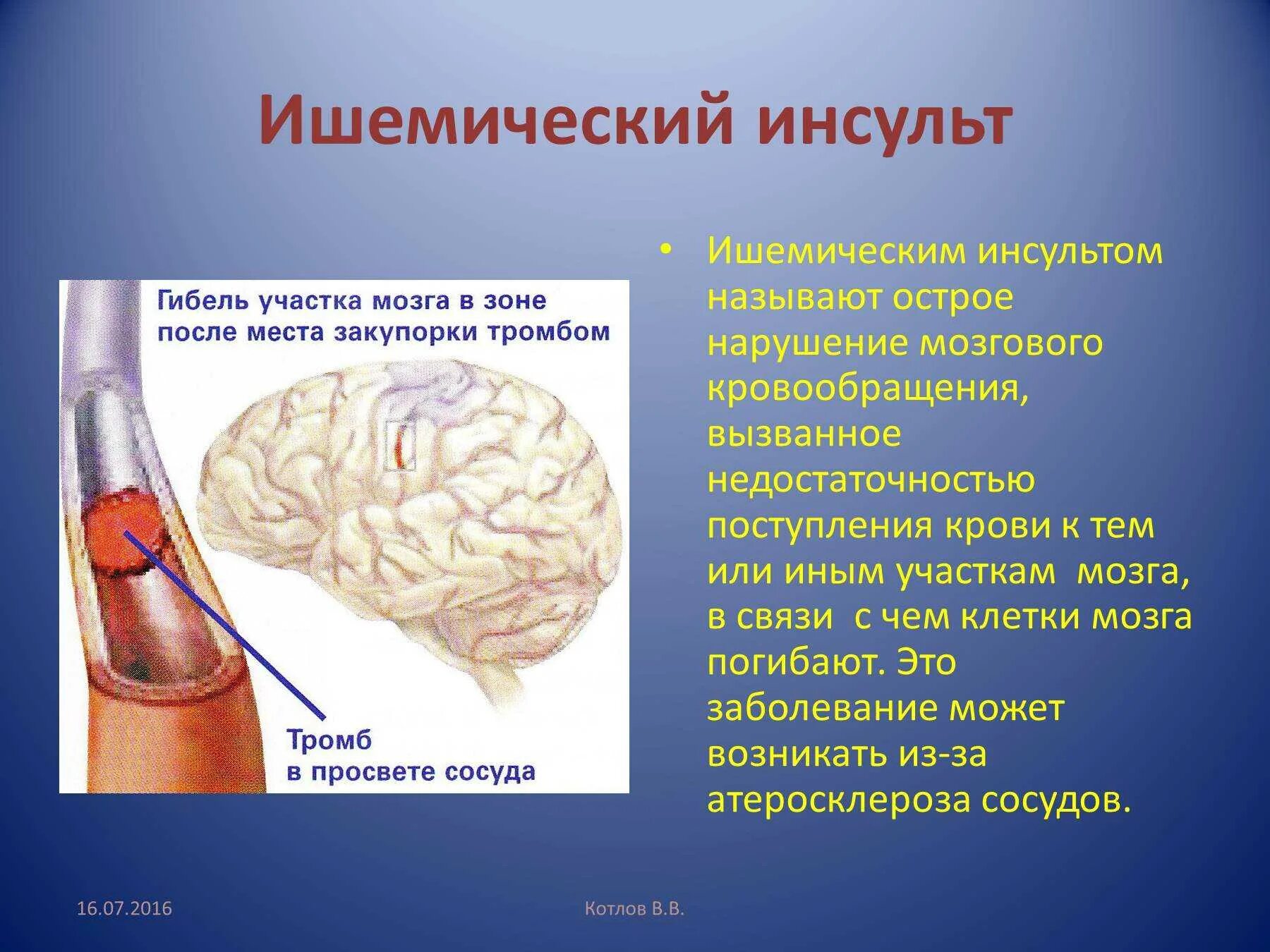 Инфаркт мозга причины. Осложнения ОНМК ишемический инсульт. Ишемический инсульт осложнения и исходы. Ишемический инсульт при ишемической болезни сердца. Ишемическом мозговом инсульте.