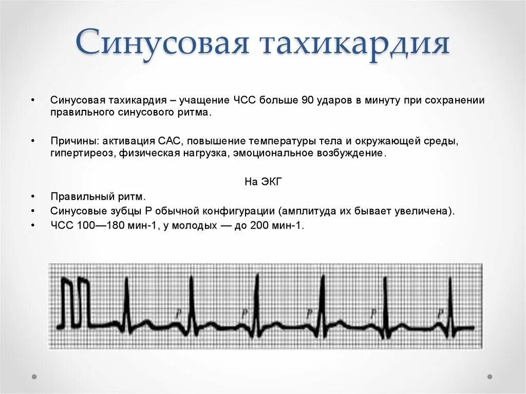 Степени тахикардии. Синусовая тахикардия экг признаки. клинические симптомы тахикардии. синусовая тахикардия аускультация. синусовая тахикардия нормы для детей.