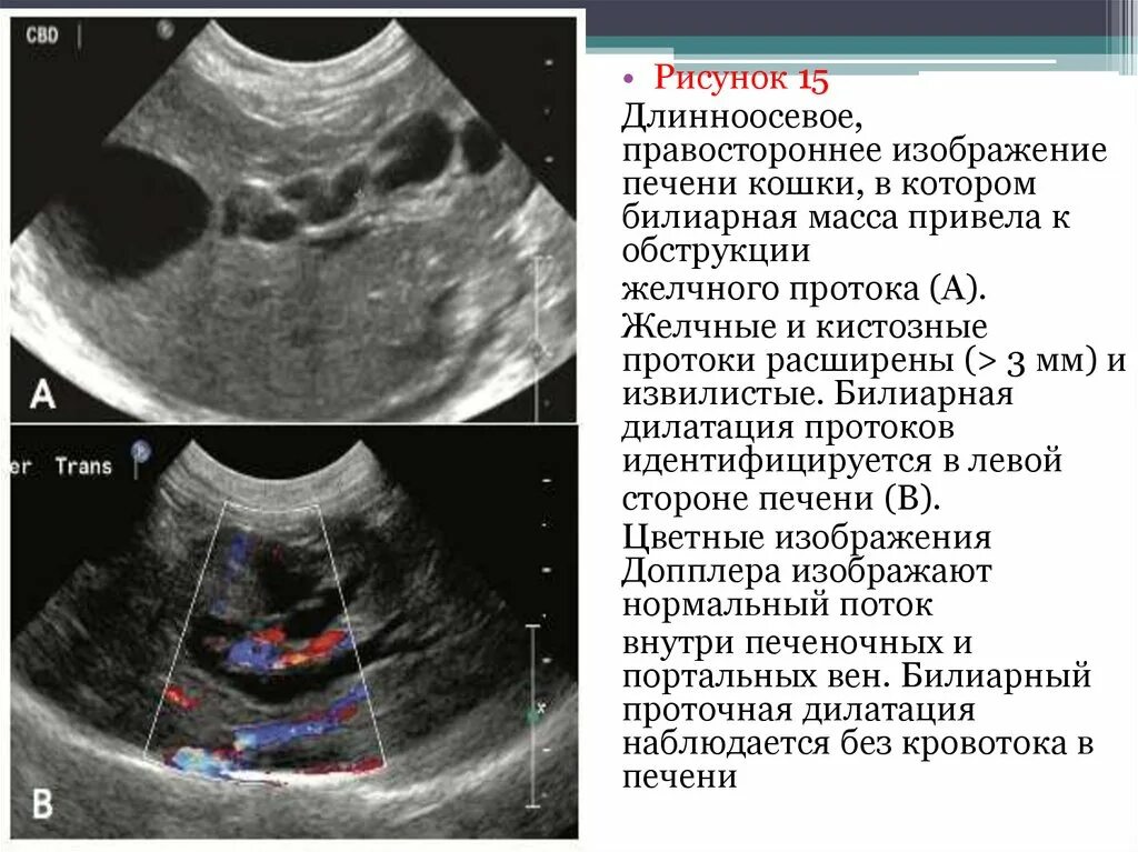Эхо признаки желчного пузыря. Расширение внутрипечёночных желчных протоков УЗИ. Расширение желчного протока на УЗИ. Желчные протоки расширены на УЗИ. Расширение желчных протоков печени.