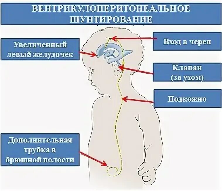 Недоношенный кровоизлияние. ВЖК 2-3 степени у новорожденных. ВЖК 1 степени у новорожденных. Внутричерепное кровоизлияние у грудничка. Вентрикулоперитонеал шунтирования.