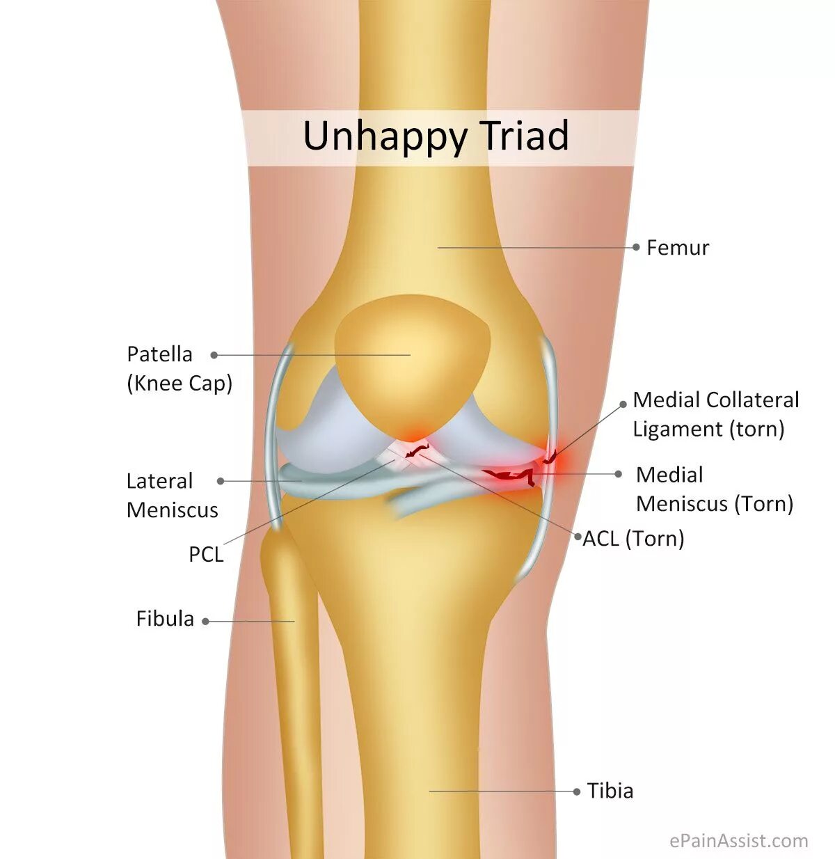Повреждение менисков левого коленного сустава. Колено мениск связки коленного сустава. Повреждение менисков коленного сустава. Внутренняя связка колена. Сустав колена повреждение.