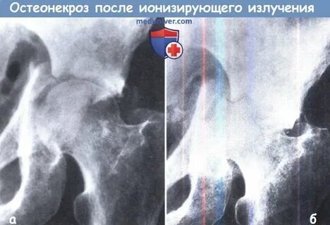 Остеонекроз лечение