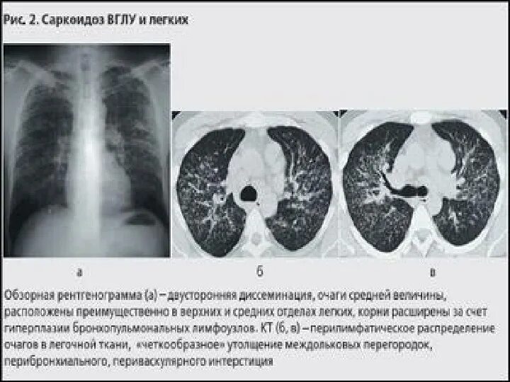Увеличение внутригрудных лимфатических узлов. Саркоидоз внутригрудных лимфатических узлов кт. саркоидоз внутригрудных лимфатических узлов рентген. саркоидоз внутригрудных лимфоузлов на кт.