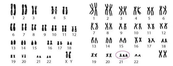 Синдром дауна лишняя хромосома. Кариотип человека с синдромом Дауна. Кариотип больного с синдромом Дауна. Синдром Дауна набор хромосом. Синдром Дауна карта хромосом.