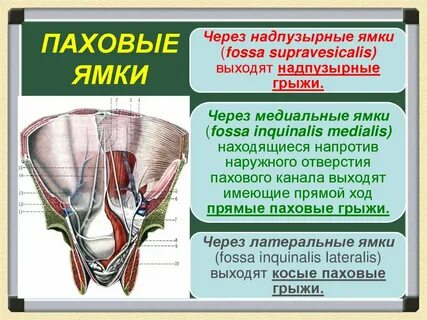 Грыжа таза