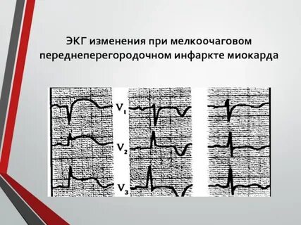 Мелкоочаговый инфаркт