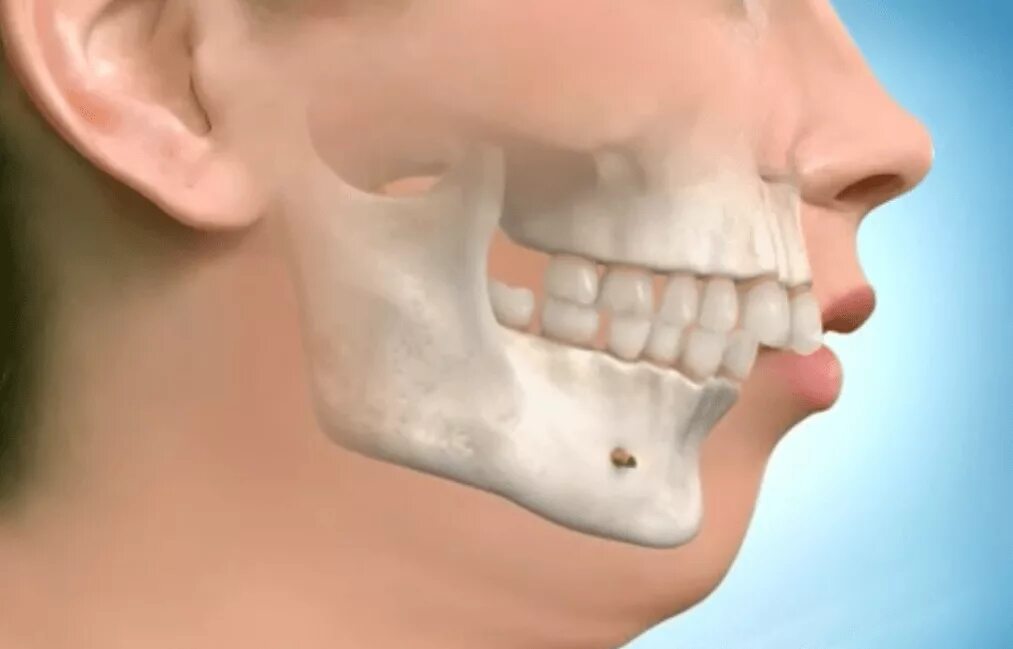 Дистальный прикус прогнатия. Почему дрожит нижняя челюсть. Второй подбородок. Дистальный (прогнатический) прикус. Дистальный прикус ретрузия.