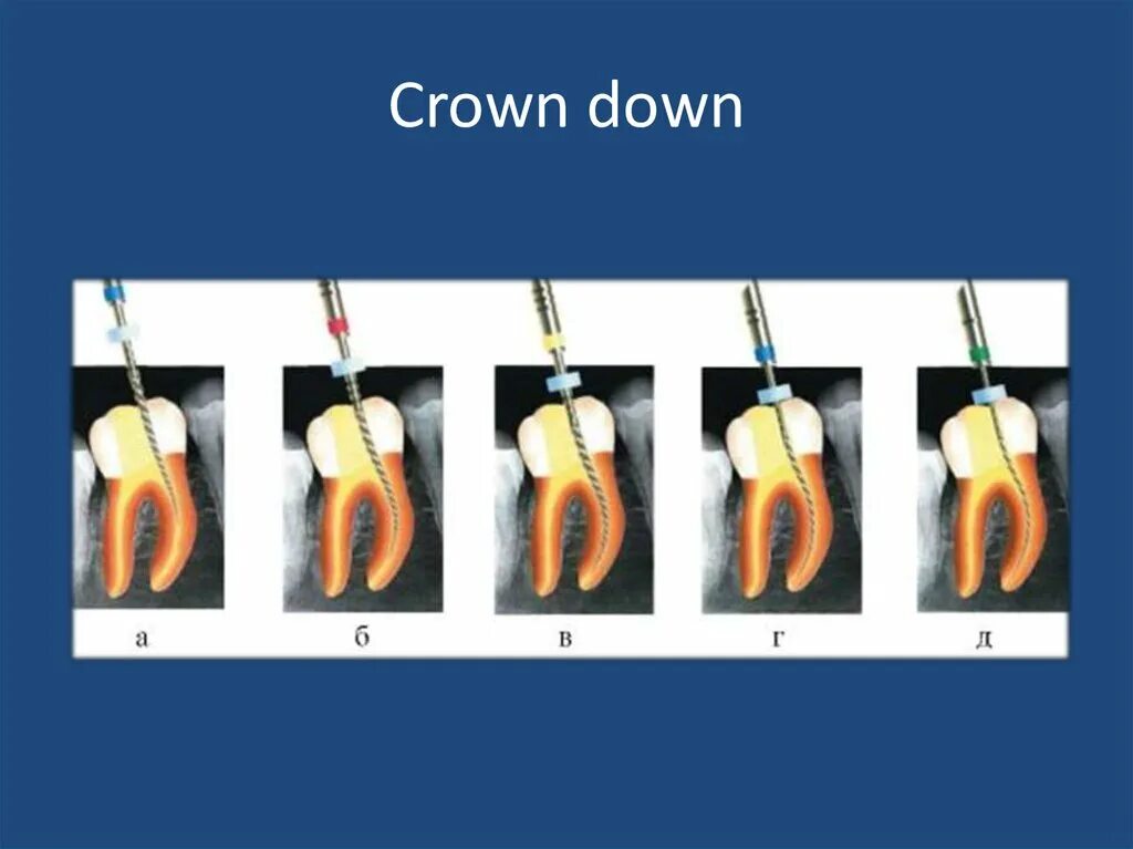 Crown down техника в эндодонтии. Краун даун техника эндодонтия. обработка корневых каналов crown down. степ даун техника эндодонтия. техника step back в эндодонтии.