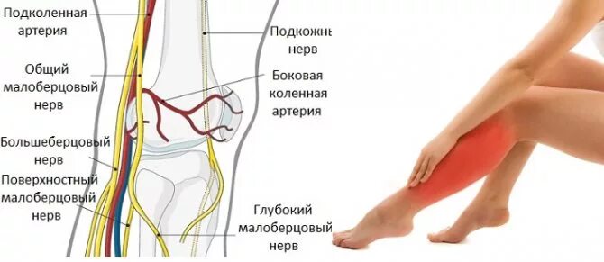 Большеберцовая нейропатия. Неврит малоберцового нерва анатомия. Туннельный синдром большеберцового нерва. Невропатия малоберцового и большеберцового нерва. Невропатия (неврит) большеберцового нерва.